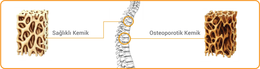 Osteoporoz Nedir?