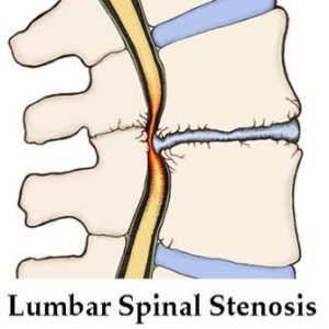 http://izmirfizyoterapi.com/wp-content/uploads/2020/02/spinal-stenosis-335x335.jpg