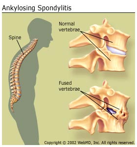 https://izmirfizyoterapi.com/wp-content/uploads/2020/03/arthritis_ankylosing_spondylitis_ankylosing_spondylitis.jpg